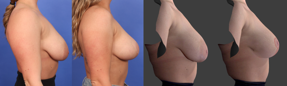 Breast Procedure Imaging Pittsburgh 